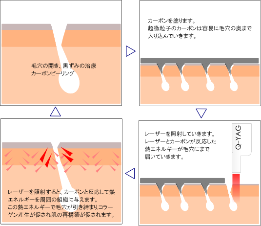 カーボンピーリングの実際 カーボンピーリングは、毛穴の開き黒ずみの治療に大変効果的な治療法です。即時的に毛穴を引き締め、コラーゲンのリモデリングにより長期的な引き締めも期待できます。