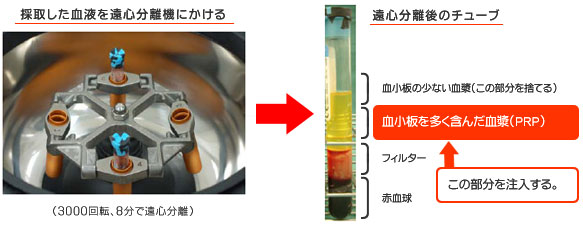 PRP皮膚再生療法 ACR療法 リジェンACR療法 PRP皮膚再生療法 ACR療法 リジェンACR療法