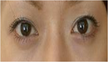 眼の下のクマ 目元のたるみ しわヒアルロン酸注入 症例写真 術後02 眼の下のクマ 目元のたるみ しわヒアルロン酸注入 症例写真 術後02