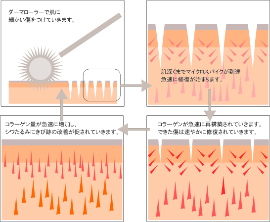 ダーマローラー療法 詳細 ダーマローラー療法 詳細