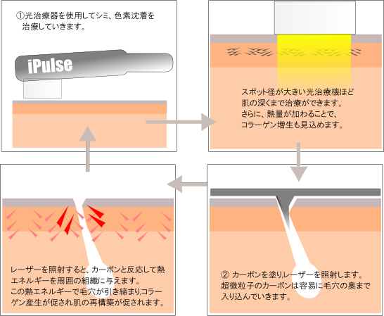 混合シミ改善治療 シミ、毛穴,にきび にきび跡,シワたるみの治療に効果的な治療です。 混合シミ改善治療 シミ、毛穴,にきび にきび跡,シワたるみの治療に効果的な治療です。