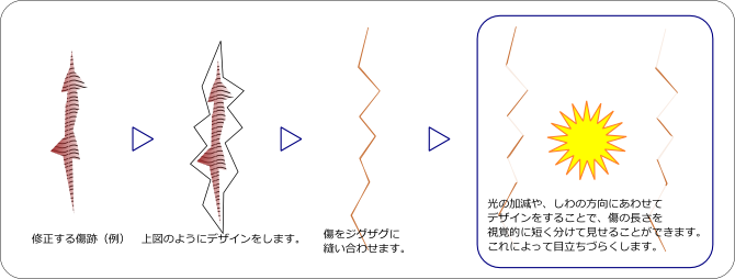 傷跡手術 瘢痕修正術 傷跡手術 瘢痕修正術